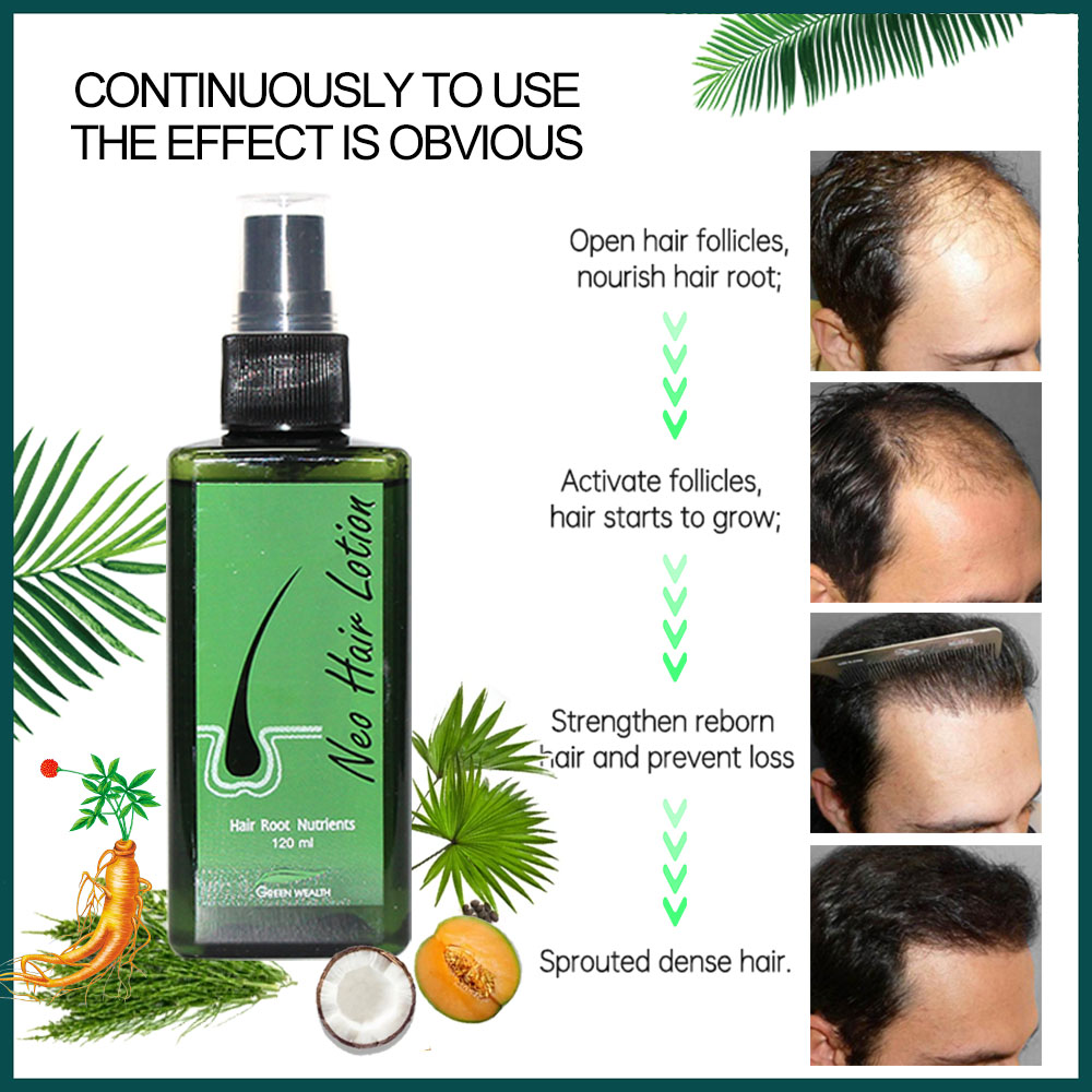 4 pcs Neo Hair Lotion 120ml Ha - Biotin Hair Growth review and price